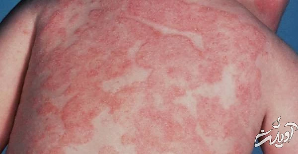 عفونت قارچی 